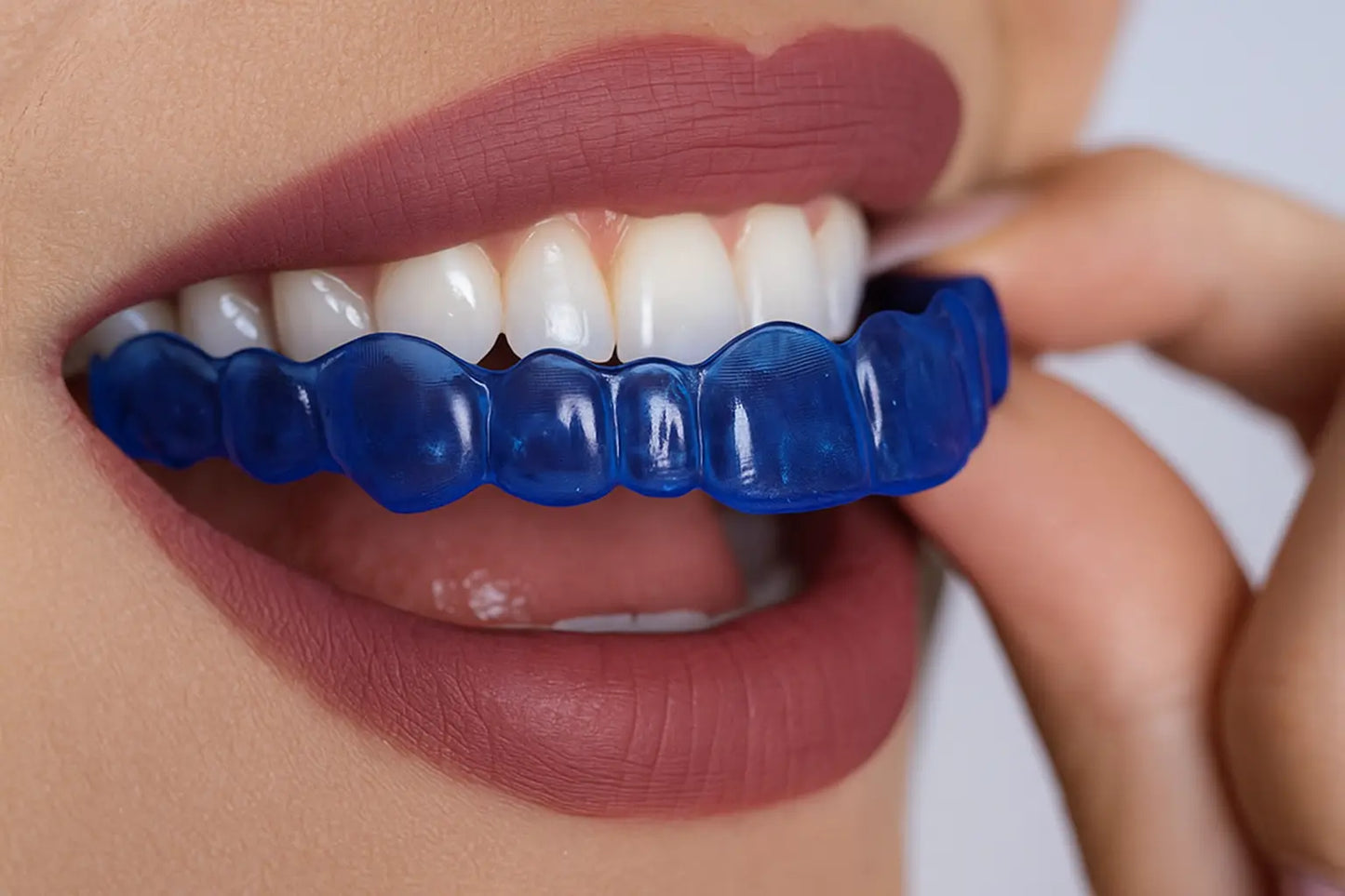 Night Shield Dental - Custom mouldable blue nightguard